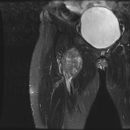 Leimyosarcoma Femoral Vein MRI Coronal T2